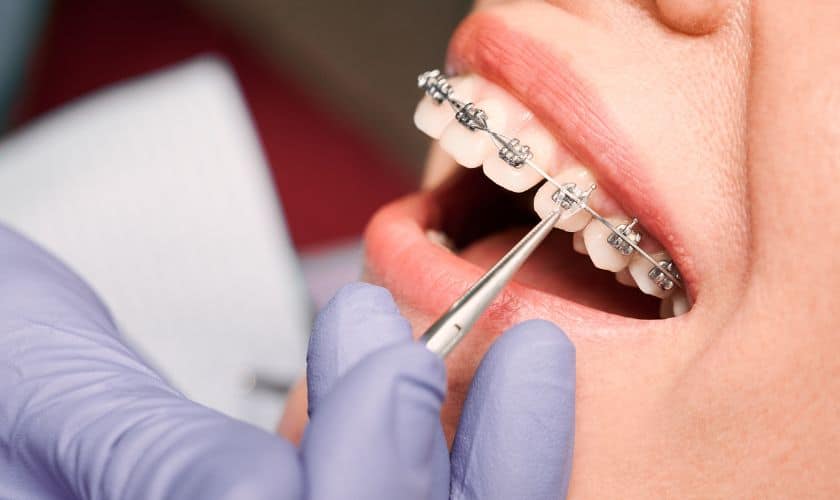 Orthodontic Treatment