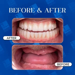 دندان مصنوعی2